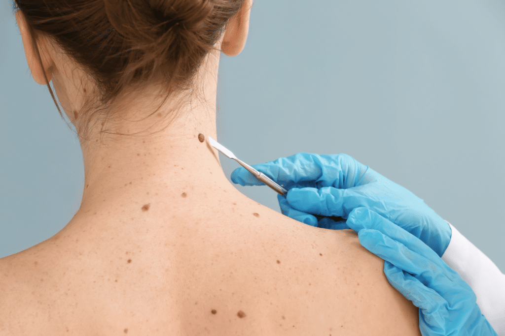 removing a mole on a woman's neck